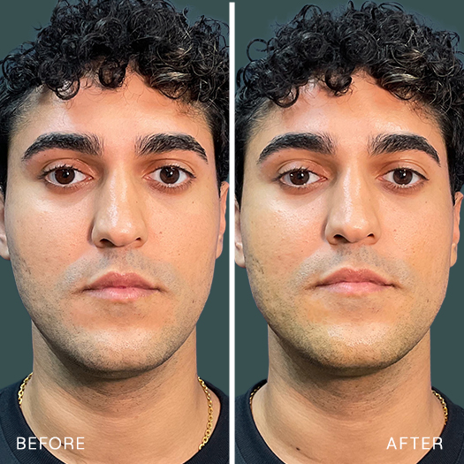 BnA-6-Male-Jawline-1