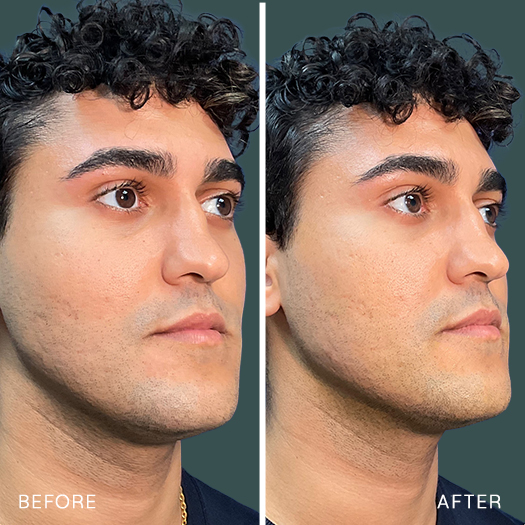 BnA-6-Male-Jawline-2
